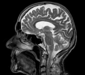 Zdjęcie MRI mózgu
