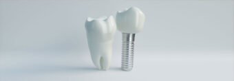 implant zęba