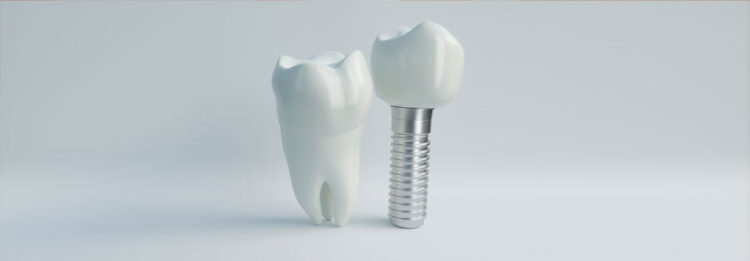 implant zęba